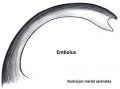Embolus