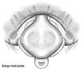 Epiygne